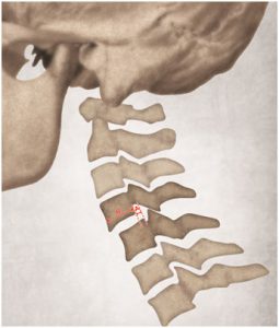 Permanent Impairment Ratings - The Final Report - ChiroSight Digital X ...